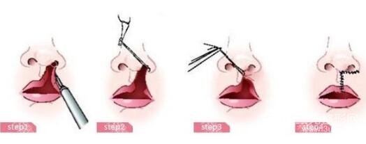 术后护理注意事项