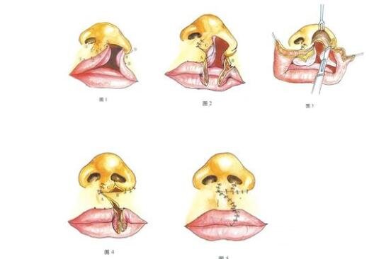 术后出现的不良影响