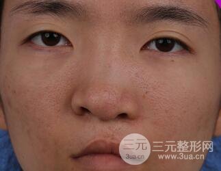 唇裂修复七天后图片恢复情况
