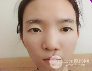 唇裂修复七天后图片恢复情况