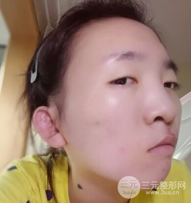 唇裂修复七天后图片恢复情况