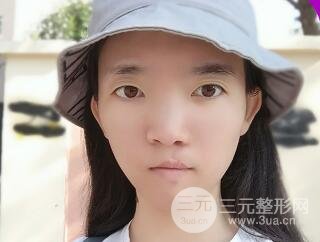 唇裂修复七天后图片恢复情况