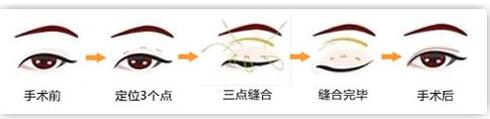 什么是韩式3点式双眼皮?