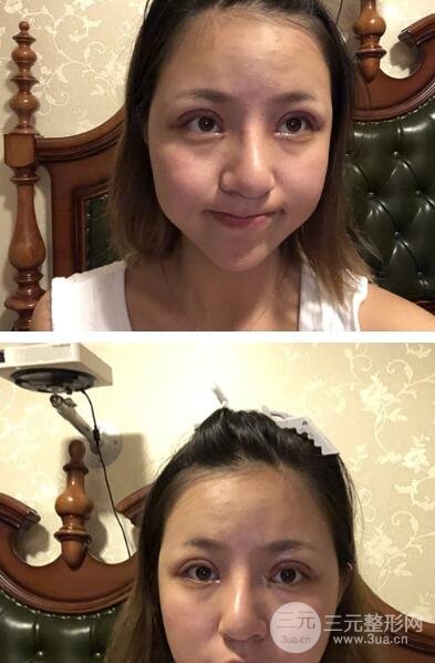 韩式3点式双眼皮案例