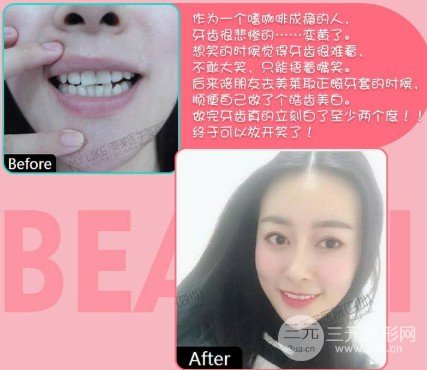 冷光美白牙齿好不好