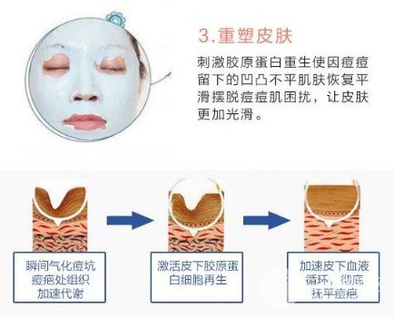 激光去痘印价格多少