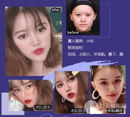 玻尿酸隆鼻能保持多久