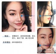 自体软骨隆鼻的价格贵吗?塌鼻子侧脸真的哭了 自体软骨隆鼻的价格贵吗?塌鼻子侧脸真的哭了