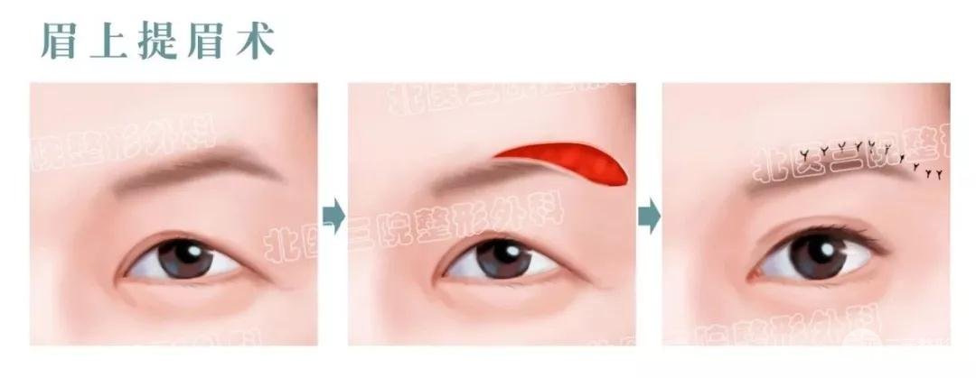 提眉术有关知识科普