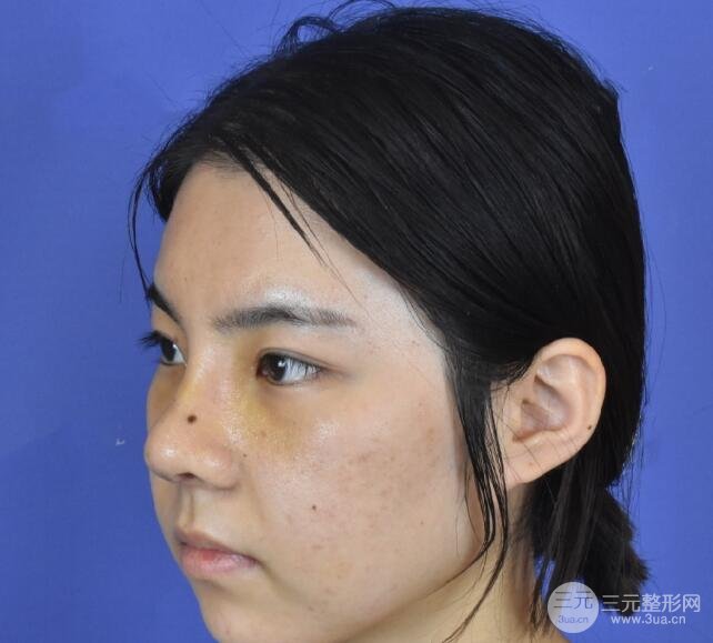 玻尿酸隆鼻手术前
