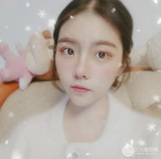 玻尿酸隆鼻一个月