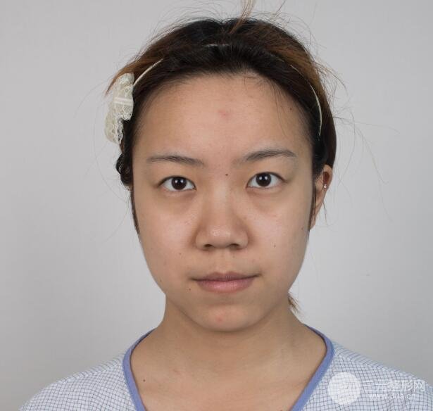 手术前的我的双眼皮