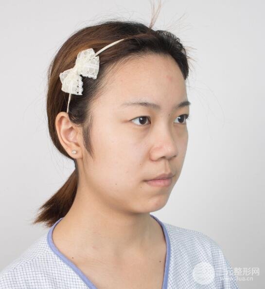 手术前的我的双眼皮
