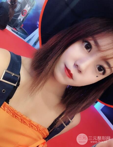 手术之后的肿泡眼不见了