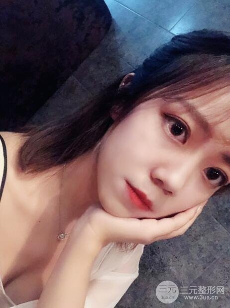 手术之后的肿泡眼不见了