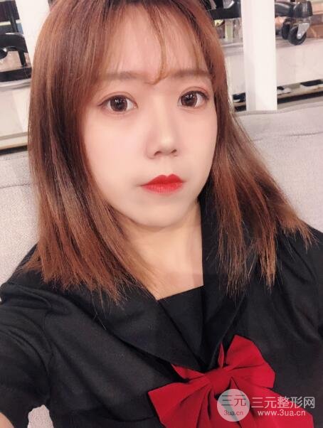 手术之后的肿泡眼不见了