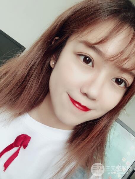 手术之后的肿泡眼不见了
