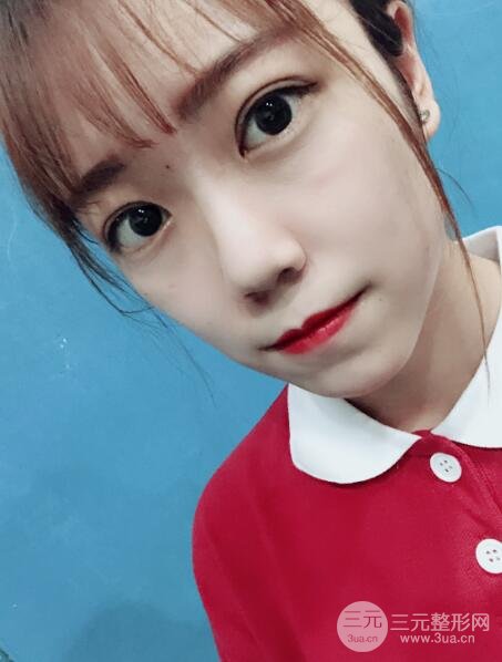 手术之后的肿泡眼不见了