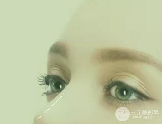 割完双眼皮一到7天图片真人术后参考,一起见证双眼皮的诞生!
