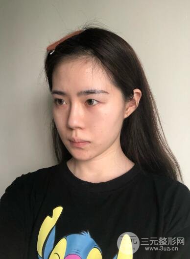 单眼皮的我