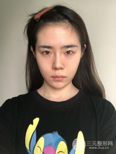 单眼皮的我