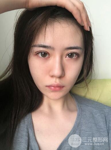 双眼皮操作中