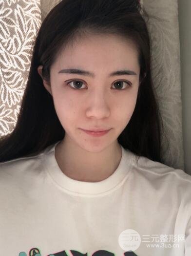 双眼皮操作中