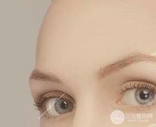 双眼皮多项整形恢复过程图真人日记参考，一次就能改变这么大？！