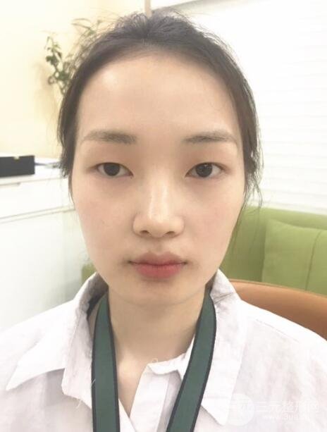 单眼皮的我