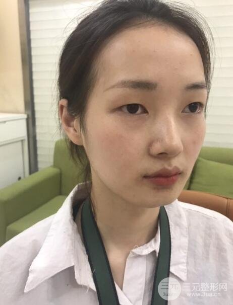 单眼皮的我