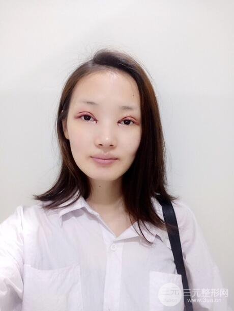 手术之后的那几天