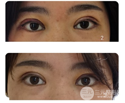 双眼皮宽度6mm