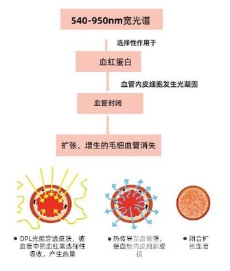 缓解红血丝多少钱