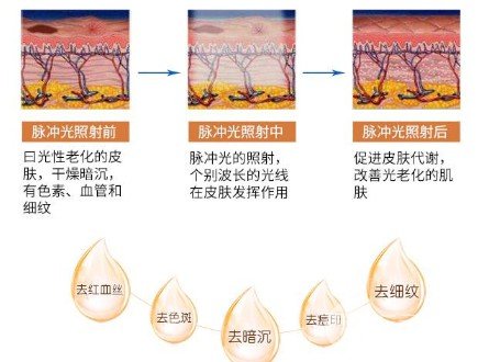 激光美白嫩肤有吗