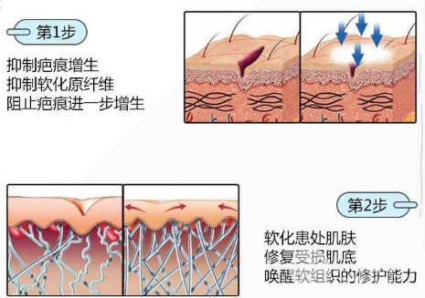 像素激光去疤痕