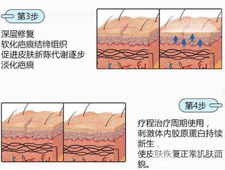 像素激光去疤痕