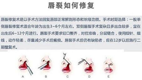 大人兔唇修复图片