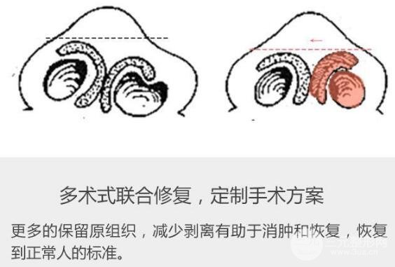 兔唇修复的方法