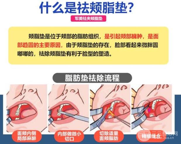 取颊脂垫合适群体