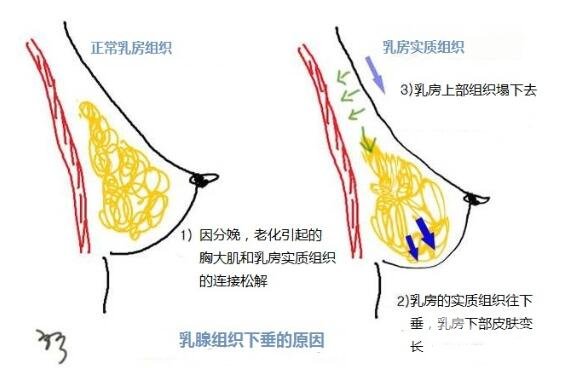 乳房下垂