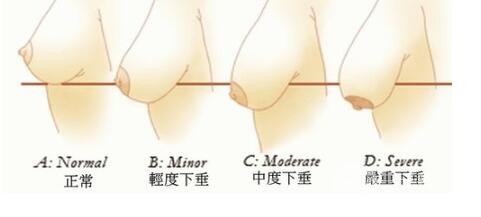 乳房矫正术的不同方案