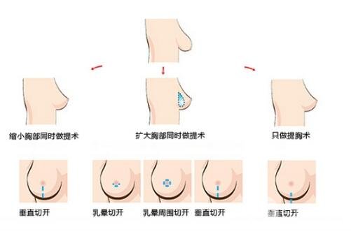 手术的优势和护理方法