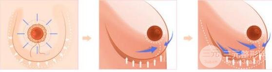 手术的优势和护理方法