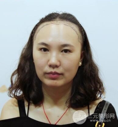 发际线移植前的我