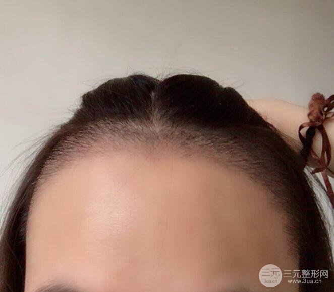 做完毛发移植后的半个月