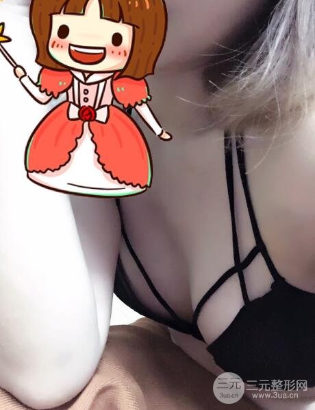 隆胸手术之后的7天