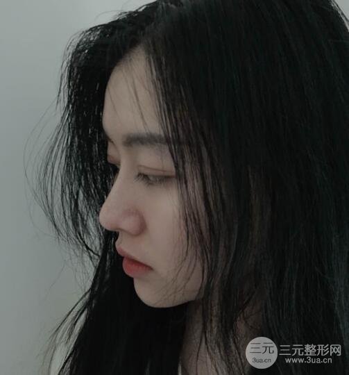 上海隆鼻案例参考