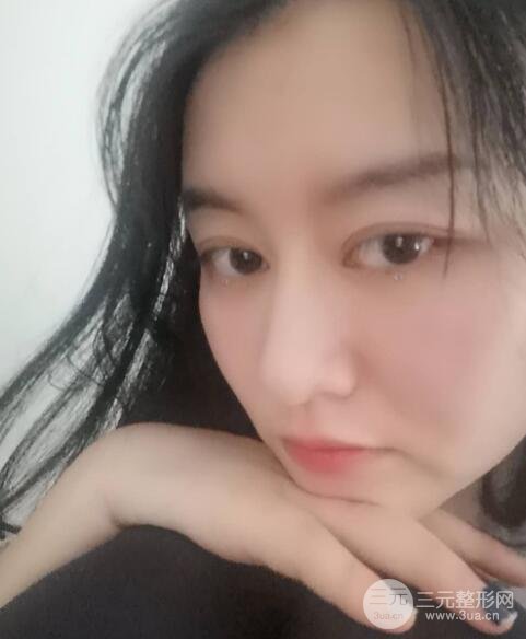 上海隆鼻案例参考