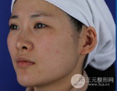 【测评】像素激光去痘印果，别说还真有点管用