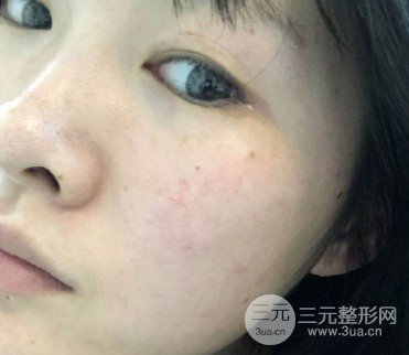 像素激光去痘印果